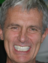 Last crown fitted with twist - Aug 2012