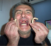 Holding my upper plastic bridges showing the 4 remaining stumps - 2004